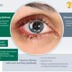 Oko z zaczerwienieniem i wydzieliną przy brzegach powiek, sugerujące problem z gruczołami Meiboma. Obok produkt EvoTears Omega.