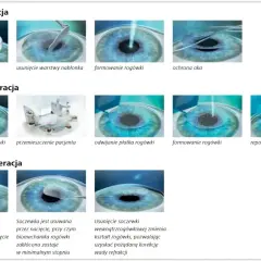 Ilustracje pokazują metody korekcji wady wzroku minus 3: PRK, LASIK i SMILE.