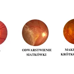 Obrazki przedstawiające dno oka: jaskra, odwarstwienie siatkówki i makulopatię krótkowzroczną. Krótkowzroczność co to?