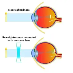 Ilustracja pokazuje wady wzroku: krótkowzroczność i jej korekcję soczewką wklęsłą. Światło skupia się przed siatkówką.
