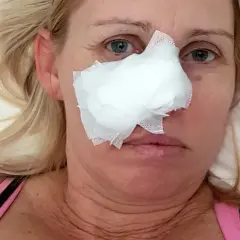 Kobieta z opatrunkiem na nosie, który powstał od odleżyny na nosie od okularów.