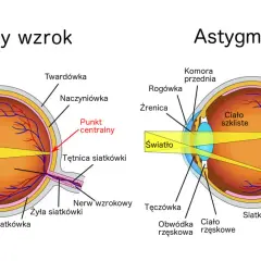 Porównanie budowy oka z astygmatyzmem i normalnym wzrokiem. Ćwiczenia na astygmatyzm mogą pomóc w poprawie ostrości widzenia.