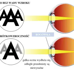 Oko zdrowe widzi ostro, oko krótkowzroczne z wydłużoną gałką oczną widzi niewyraźnie. Ile dioptrii to ślepota? To zależy od przyczyny.