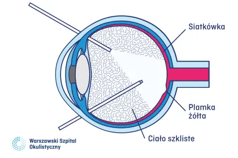 Schemat oka z zaznaczonym ciałem szklistym. Zmiany w ciele szklistym mogą być jedną z przyczyn szklistych oczu.