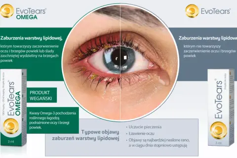 Oko z zaczerwienieniem i wydzieliną przy brzegach powiek, sugerujące problem z gruczołami Meiboma. Obok produkt EvoTears Omega.