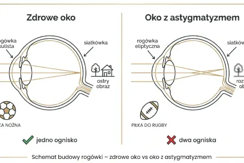 Zdrowe oko z kulistą rogówką skupia światło w jednym ognisku, dając ostry obraz. Oko z astygmatyzmem i eliptyczną rogówką tworzy dwa ogniska, co skutkuje rozmytym obrazem.