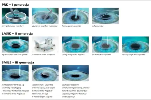 Ilustracje pokazują metody korekcji wady wzroku minus 3: PRK, LASIK i SMILE.