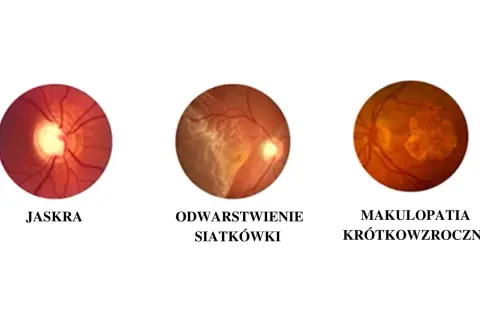 Trzy obrazy dna oka: jaskra, odwarstwienie siatkówki i makulopatia krótkowzroczna. Schorzenia te mogą prowadzić do zawężenia pola widzenia.