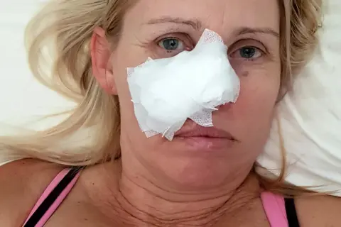 Kobieta z opatrunkiem na nosie, który powstał od odleżyny na nosie od okularów.
