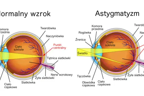 Porównanie budowy oka z astygmatyzmem i normalnym wzrokiem. Ćwiczenia na astygmatyzm mogą pomóc w poprawie ostrości widzenia.
