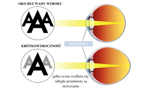 Oko zdrowe widzi ostro, oko krótkowzroczne z wydłużoną gałką oczną widzi niewyraźnie. Ile dioptrii to ślepota? To zależy od przyczyny.