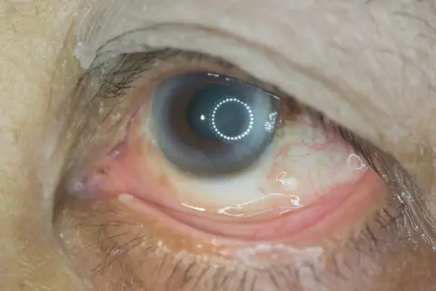 Oko z widocznymi zmianami, zaczerwienieniem spojówki i białymi grudkami. Może to być objaw retinopatii oka lub innych schorzeń.