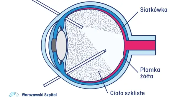 Schemat oka z zaznaczonym ciałem szklistym. Zmiany w ciele szklistym mogą być jedną z przyczyn szklistych oczu.