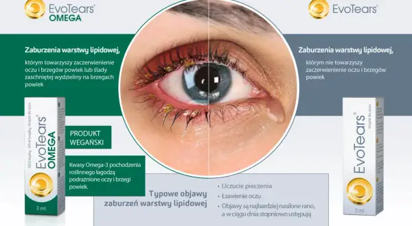 Oko z zaczerwienieniem i wydzieliną przy brzegach powiek, sugerujące problem z gruczołami Meiboma. Obok produkt EvoTears Omega.