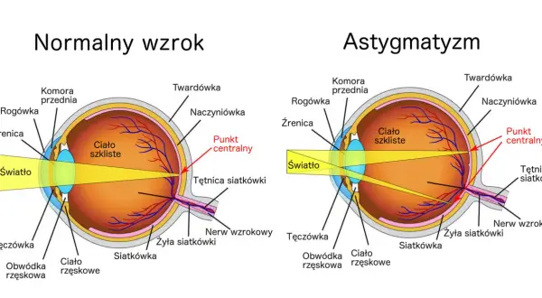 Porównanie budowy oka z astygmatyzmem i normalnym wzrokiem. Ćwiczenia na astygmatyzm mogą pomóc w poprawie ostrości widzenia.