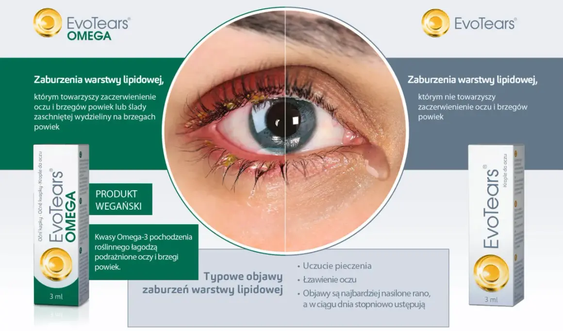 Oko z zaczerwienieniem i wydzieliną przy brzegach powiek, sugerujące problem z gruczołami Meiboma. Obok produkt EvoTears Omega.