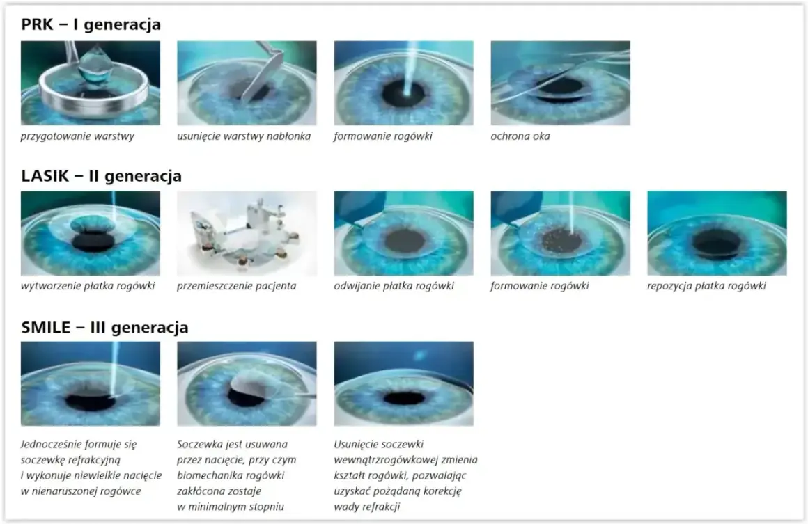 Ilustracje pokazują metody korekcji wady wzroku minus 3: PRK, LASIK i SMILE.