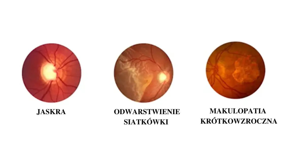 Trzy obrazy dna oka: jaskra, odwarstwienie siatkówki i makulopatia krótkowzroczna. Schorzenia te mogą prowadzić do zawężenia pola widzenia.