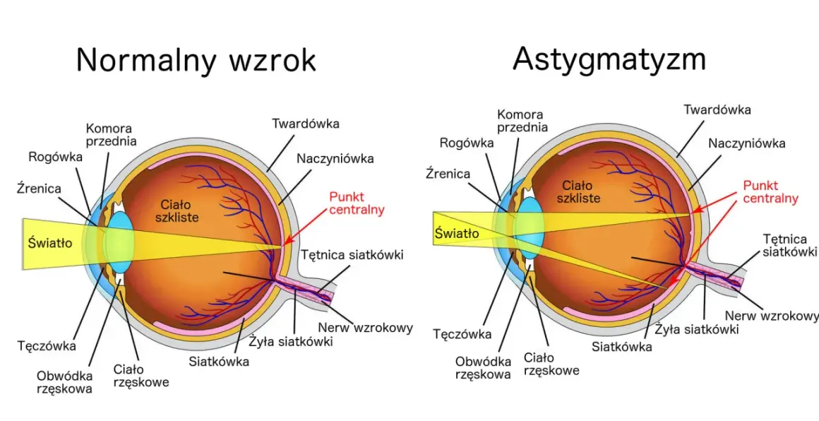 Porównanie budowy oka z astygmatyzmem i normalnym wzrokiem. Ćwiczenia na astygmatyzm mogą pomóc w poprawie ostrości widzenia.