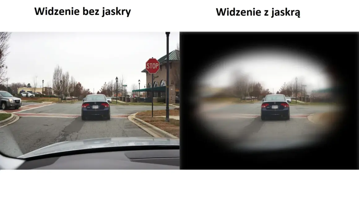 Widzenie z jaskrą jest jak patrzenie przez mglisty tunel, gdzie centrum jest rozmazane, a krawędzie ciemne.