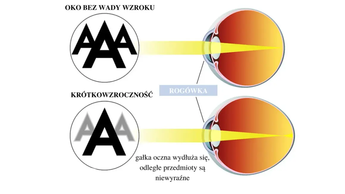 Oko zdrowe widzi ostro, oko krótkowzroczne z wydłużoną gałką oczną widzi niewyraźnie. Ile dioptrii to ślepota? To zależy od przyczyny.