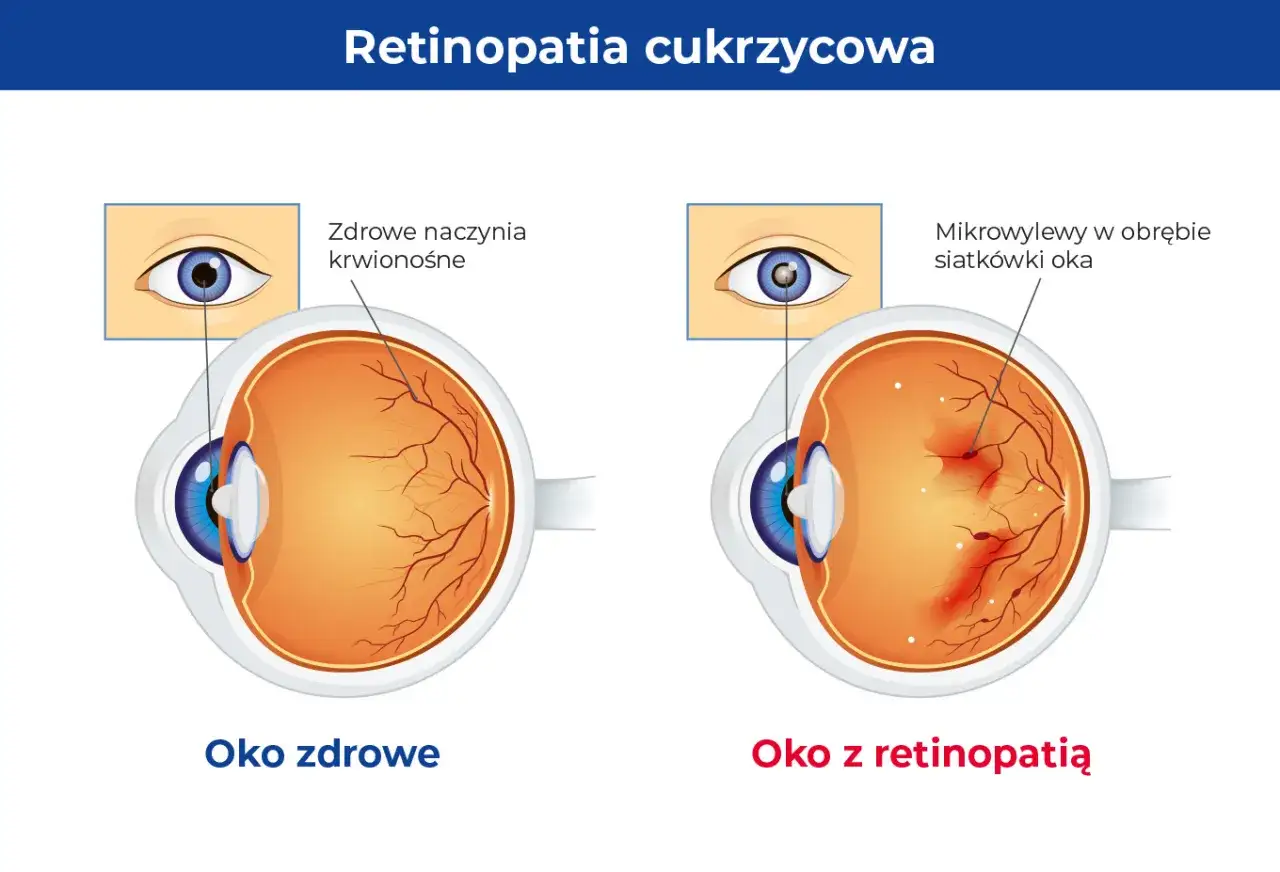 Porównanie zdrowego oka z naczyniami krwionośnymi siatkówki i oka z retinopatią, gdzie widoczne są mikrowylewy.
