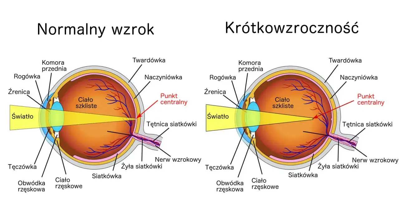 Porównanie budowy oka z normalnym wzrokiem i krótkowzrocznością. Czy wada wzroku minus może się cofnąć? Ilustracja pokazuje, jak światło skupia się inaczej.