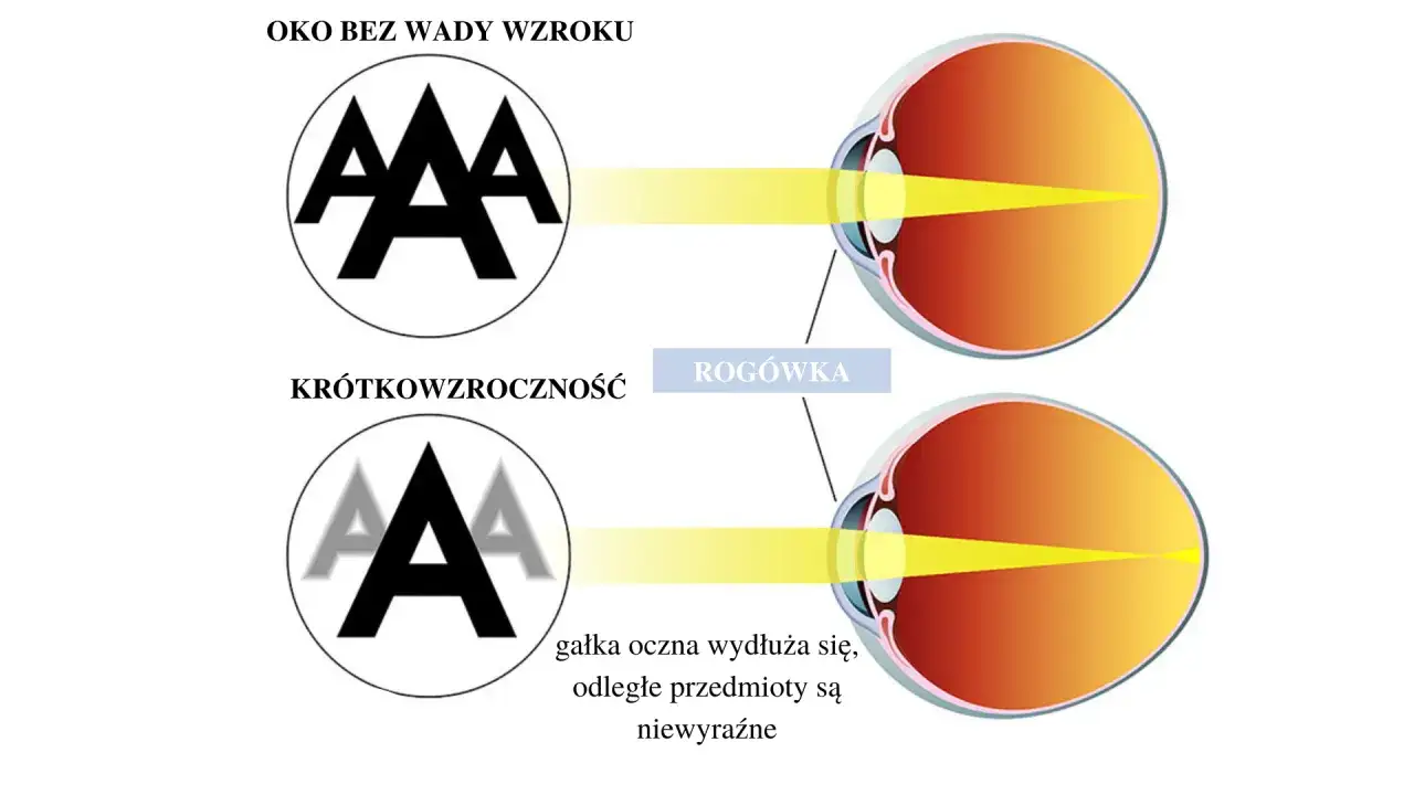 Oko bez wady wzroku widzi ostro. Krótkowzroczność (wada wzroku - 20) powoduje, że gałka oczna się wydłuża, a odległe przedmioty są niewyraźne.