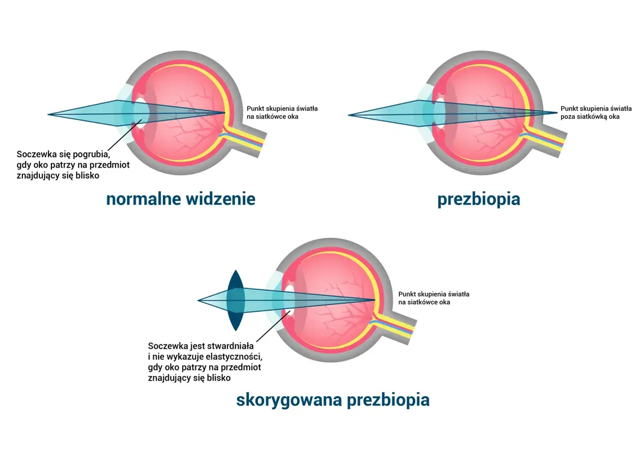 Ilustracja porównująca normalne widzenie, prezbiopię i skorygowaną prezbiopię, pokazująca skupienie światła w oku.