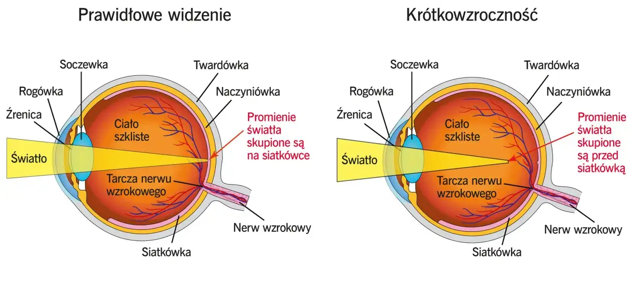 Porównanie oka z wadą wzroku minus (krótkowzroczność) i prawidłowego widzenia. Promienie światła skupiają się przed siatkówką.
