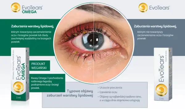 Oko z zaczerwienieniem i wydzieliną przy brzegach powiek, sugerujące problem z gruczołami Meiboma. Obok produkt EvoTears Omega.
