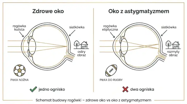 Zdrowe oko z kulistą rogówką skupia światło w jednym ognisku, dając ostry obraz. Oko z astygmatyzmem i eliptyczną rogówką tworzy dwa ogniska, co skutkuje rozmytym obrazem.