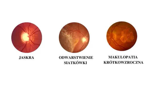 Obrazki przedstawiające dno oka: jaskra, odwarstwienie siatkówki i makulopatię krótkowzroczną. Krótkowzroczność co to?