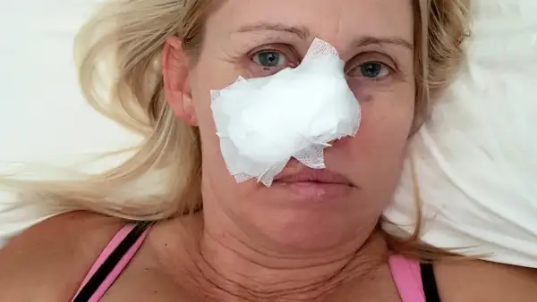 Kobieta z opatrunkiem na nosie, który powstał od odleżyny na nosie od okularów.