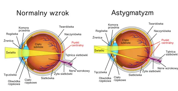 Porównanie budowy oka z astygmatyzmem i normalnym wzrokiem. Ćwiczenia na astygmatyzm mogą pomóc w poprawie ostrości widzenia.