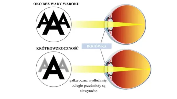 Oko zdrowe widzi ostro, oko krótkowzroczne z wydłużoną gałką oczną widzi niewyraźnie. Ile dioptrii to ślepota? To zależy od przyczyny.